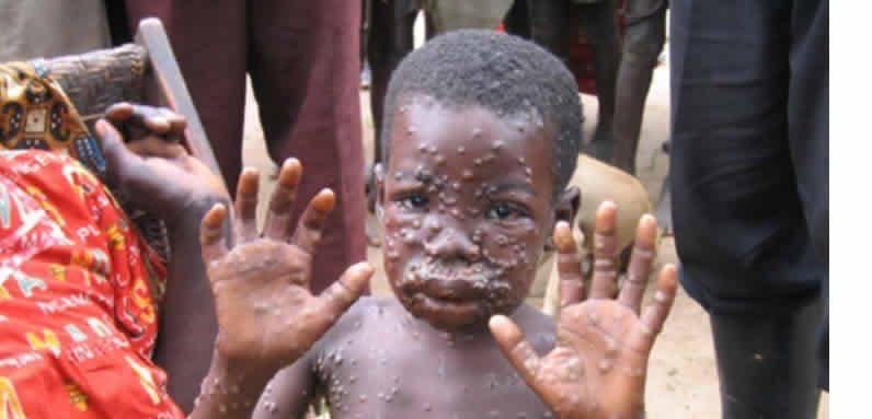 Monkeypox outbreak in Nigerian amid Covid-19 upsurge